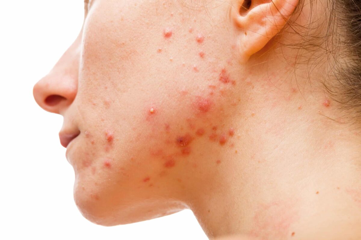 Leia mais sobre o artigo Cuidados com a Acne na Clínica Natuee: Soluções Eficazes