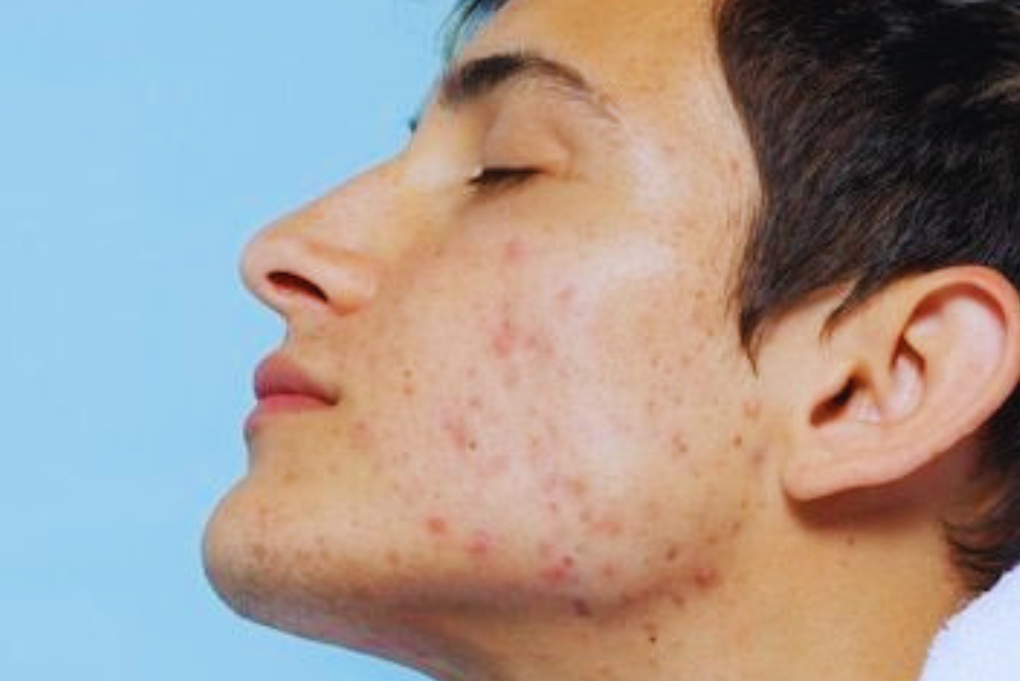 Leia mais sobre o artigo Dicas para Cuidar da Pele Oleosa e Evitar Acne