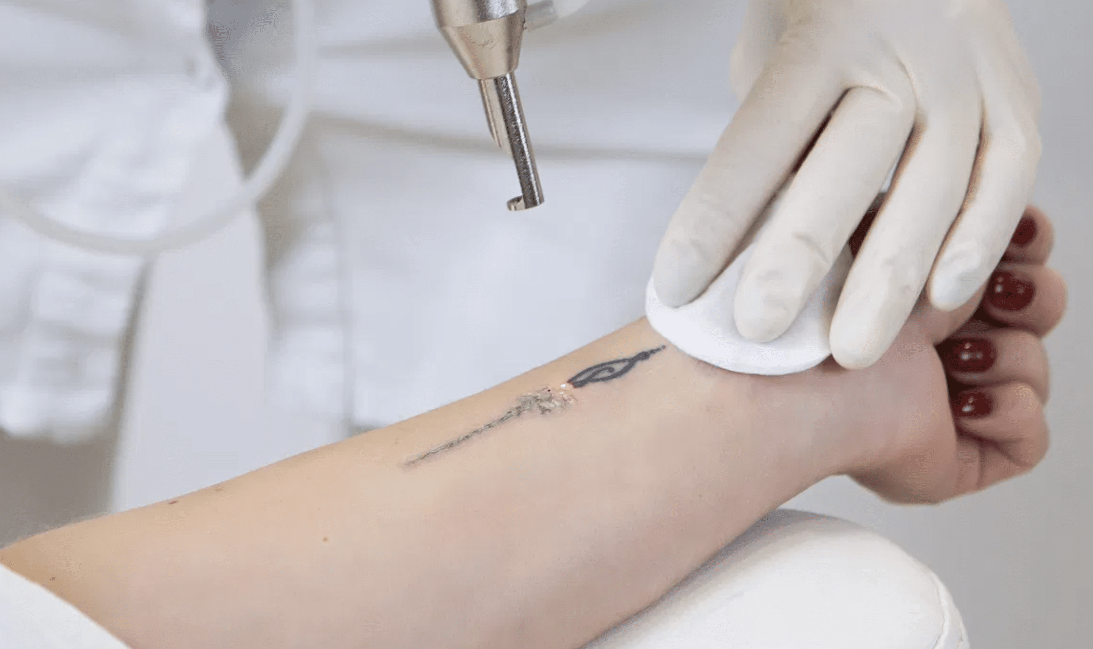 Leia mais sobre o artigo Remoção de Tatuagem – Clínica Natuee