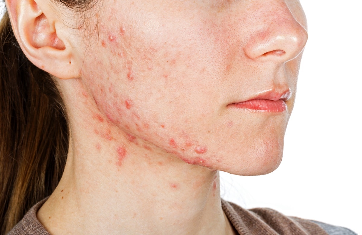 Leia mais sobre o artigo Acne Adulta: Causas, Mitos e Tratamentos Eficazes