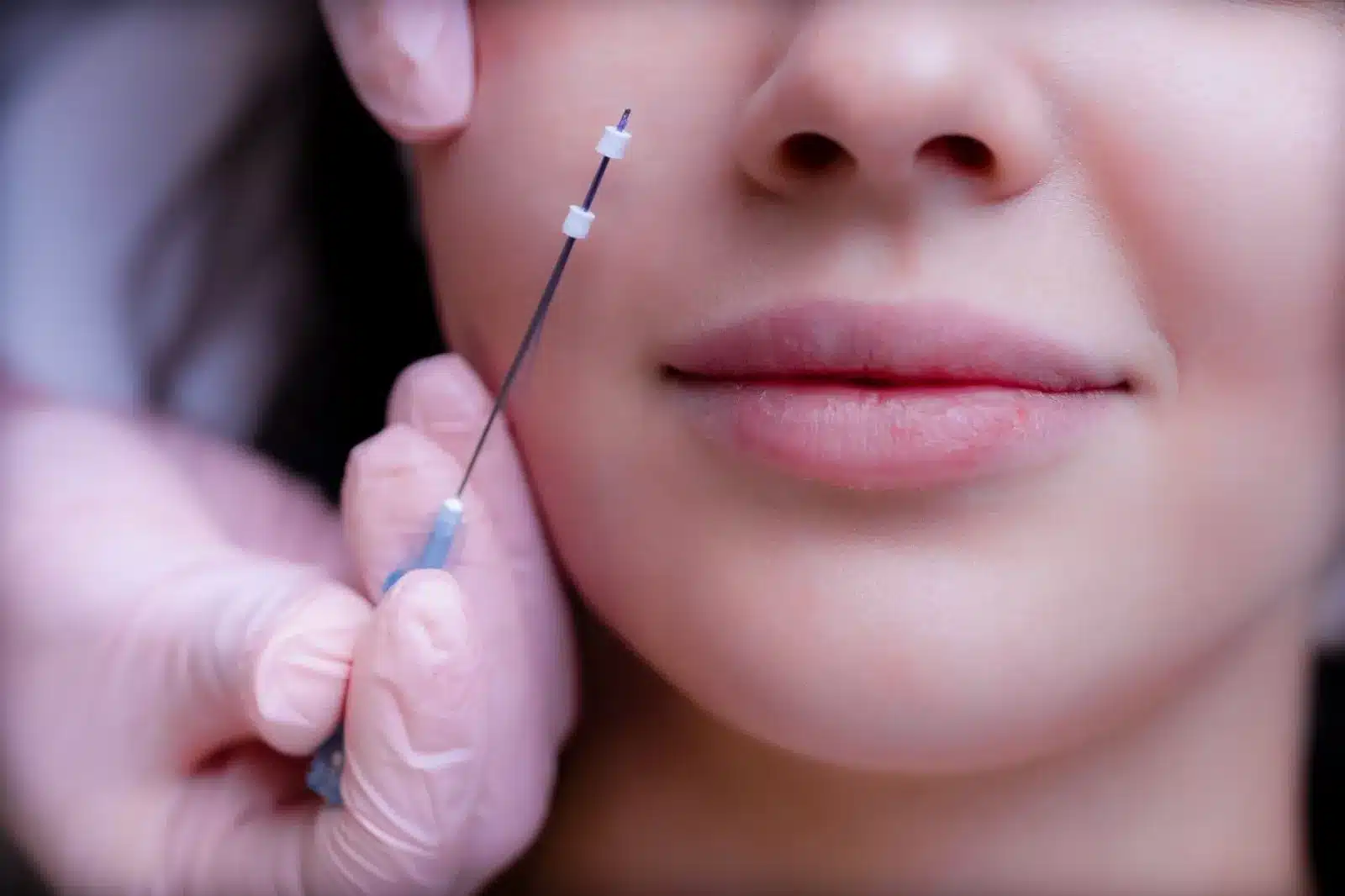 Leia mais sobre o artigo Fios de PDO e Fios Lisos: diferenças, benefícios e resultados no rejuvenescimento facial